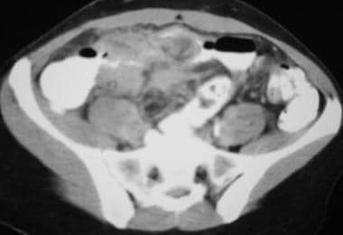 克罗恩病。肠系膜炎症。CT Scan De.