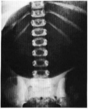 Supine abdominal image shows a mesenteroaxial volv