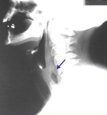 Cervical abscess following esophageal injury subse