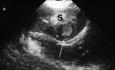 Renal ultrasonogram obtained in a 12-year-old boy 