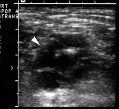 Transverse ultrasonographic image of the popliteal
