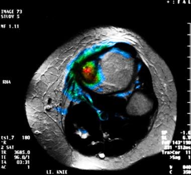 Fusion magnetic resonance imaging (MRI) and positr