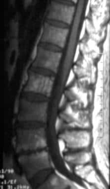 Bone hemangioma. Sagittal T1-weighted MRI of a spi