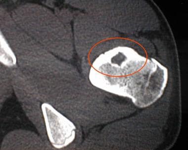 Computed tomography scan of the left proximal femu