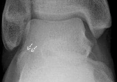Patient OA. Lateral process of talus fracture, ant