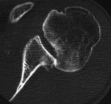 Shoulder computed tomography scan: Posterior dislo