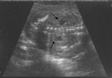 Coronal prenatal ultrasonogram of the abdomen show