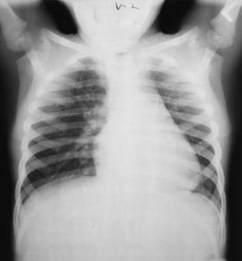 Chest radiograph obtained 2 days after a piece of 