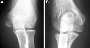 Medial epicondyle fracture with distal displacemen