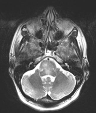 Axial T2 image showing a pontine mass consistent w