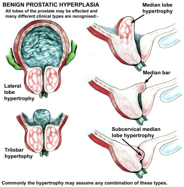 Benign prostatic hypertrophy of the lateral and me