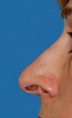 Nonoperated nose with alar retraction. (Images use