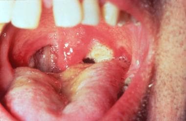 Granulomatosis with polyangiitis (GPA). Large ulce