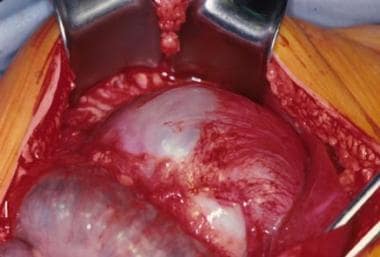 An intraoperative view of a gastric teratoma being