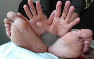 Typical flat vesicular lesions of hand, foot, and 