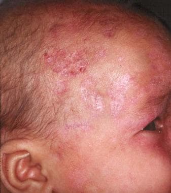 neonatal lupus erythematosus