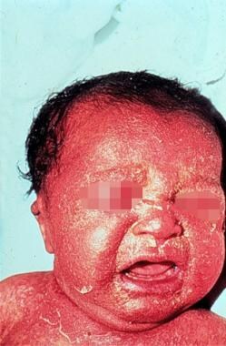 An infant with characteristic coloring of the skin
