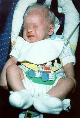 Infant with Chediak-Higashi syndrome presenting wi