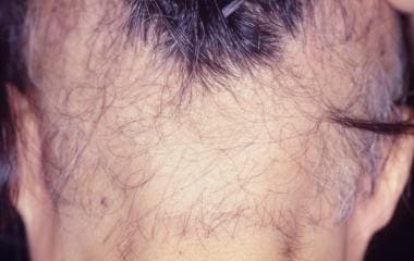 Woman with severe long-standing lesions from trich