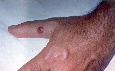 An early lesion of orf (papular stage). 