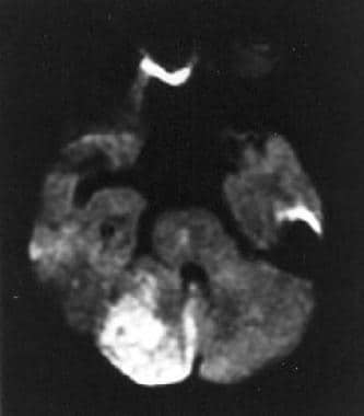 Diffusion-weighted MRI images showing a right cere