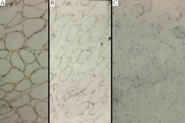 (A) Normal dystrophin staining.(B) Intermediate dy
