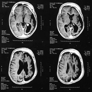 leptomeningeal angiomas