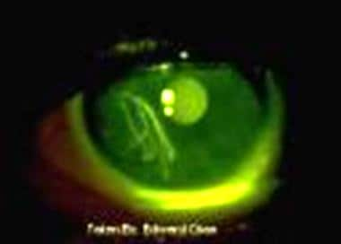 scleral abrasion fluorescein