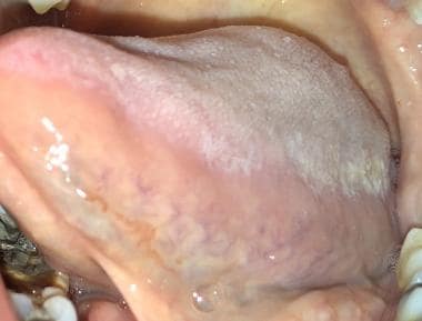 Oral hairy leukoplakia (OHL) on left lateral tongu