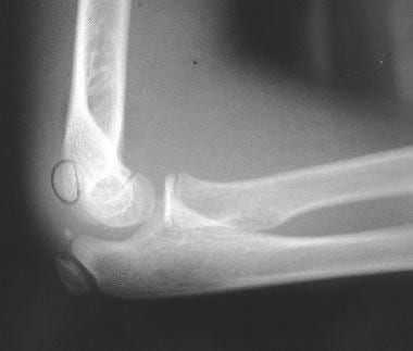 Elbow dislocation associated with medial epicondyl
