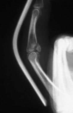 middle phalanx fracture