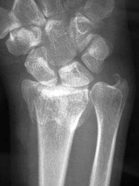 Colle Fracture - Distal Radial Fracture, Radiology Case