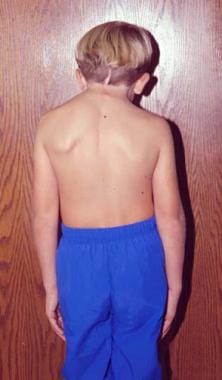 A photograph of a child with Sprengel's deformity: (A) asymmetry of