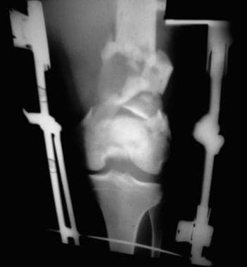 Supracondylar femur fracture treated in traction. 