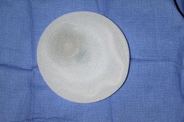 Expander-implant breast reconstruction. Textured s