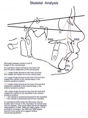 Lateral cephalometric analysis of the facial skele