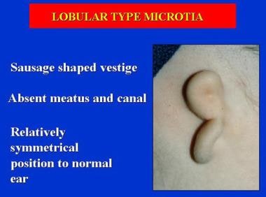 Lobular type microtia. 