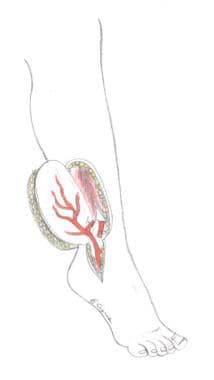 Perforator flap from the peroneal artery. 