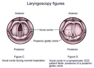 Laryngoscopic views of the vocal cords. 