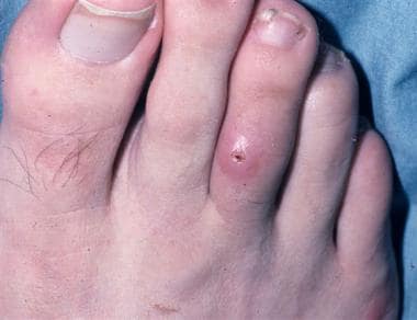 Boil-like lesion on toe of a patient with botfly m