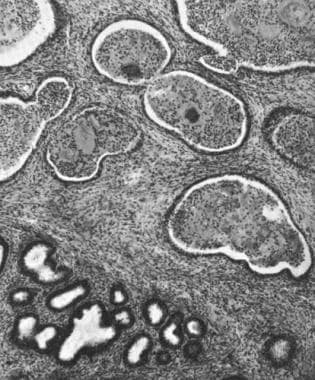 Leukocytic infiltration of the stroma and glandula