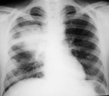 Posteroanterior (PA) chest radiograph shows a larg