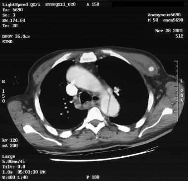 Aortic dissection. CT scan showing a flap (right s