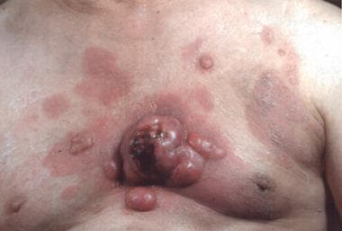 Tumor-stage mycosis fungoides. 