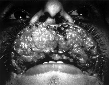 Mucocutaneous leishmaniasis. Courtesy of Kenneth F