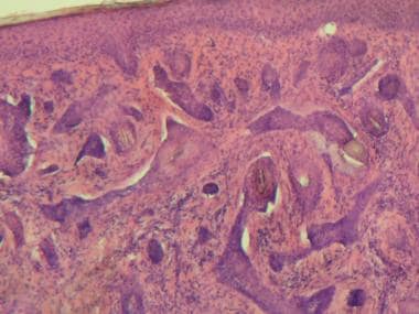 Which Histologic Findings Are Characteristic Of Infiltrative Basal