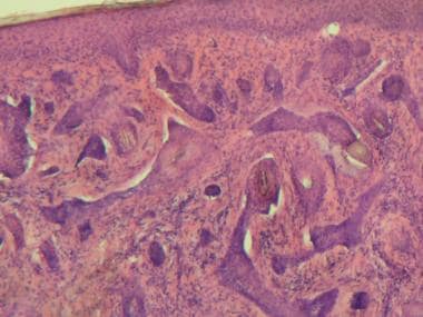 morpheaform basal cell carcinoma histology