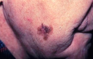 Lentigo maligna melanoma, right lower cheek. The c