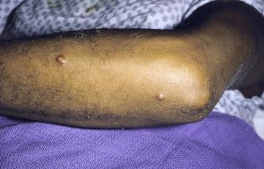 Swollen elbow and nodules on the forearm. 