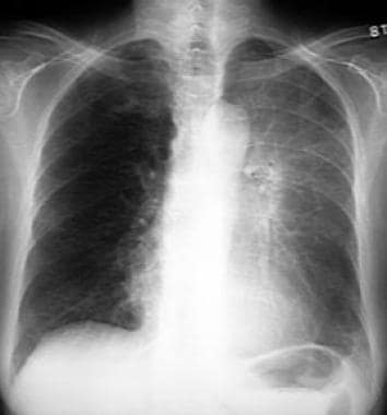 Atelectasis. Left upper lobe collapse. The top of 